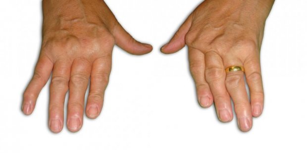 Les places des sangsues au psoriasis