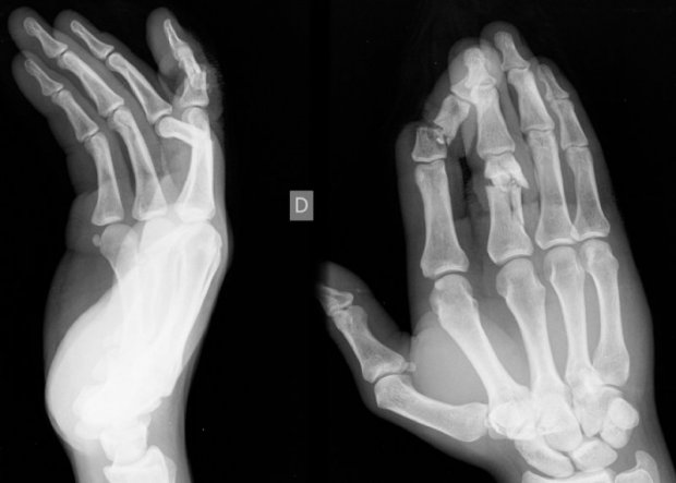 comminuted fracture hand