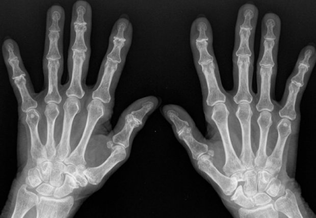 Osteoarthritis Of The Fingers | Www.hand-surgery.eu