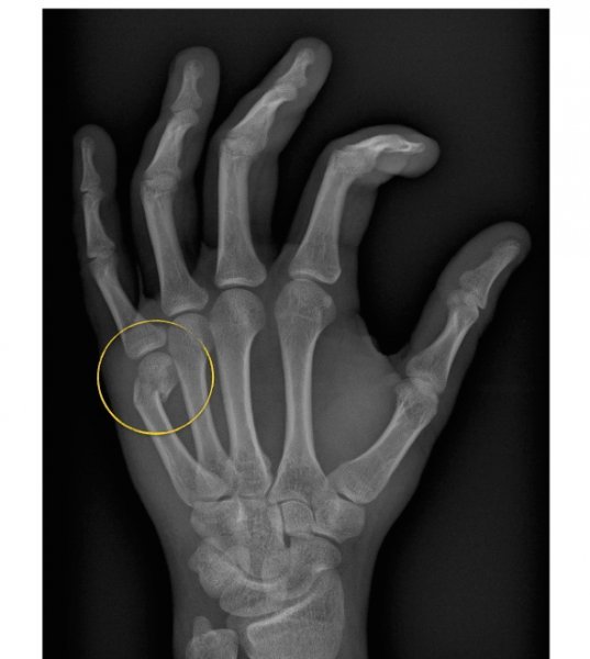 Fracture du boxeur www.handsurgery.eu